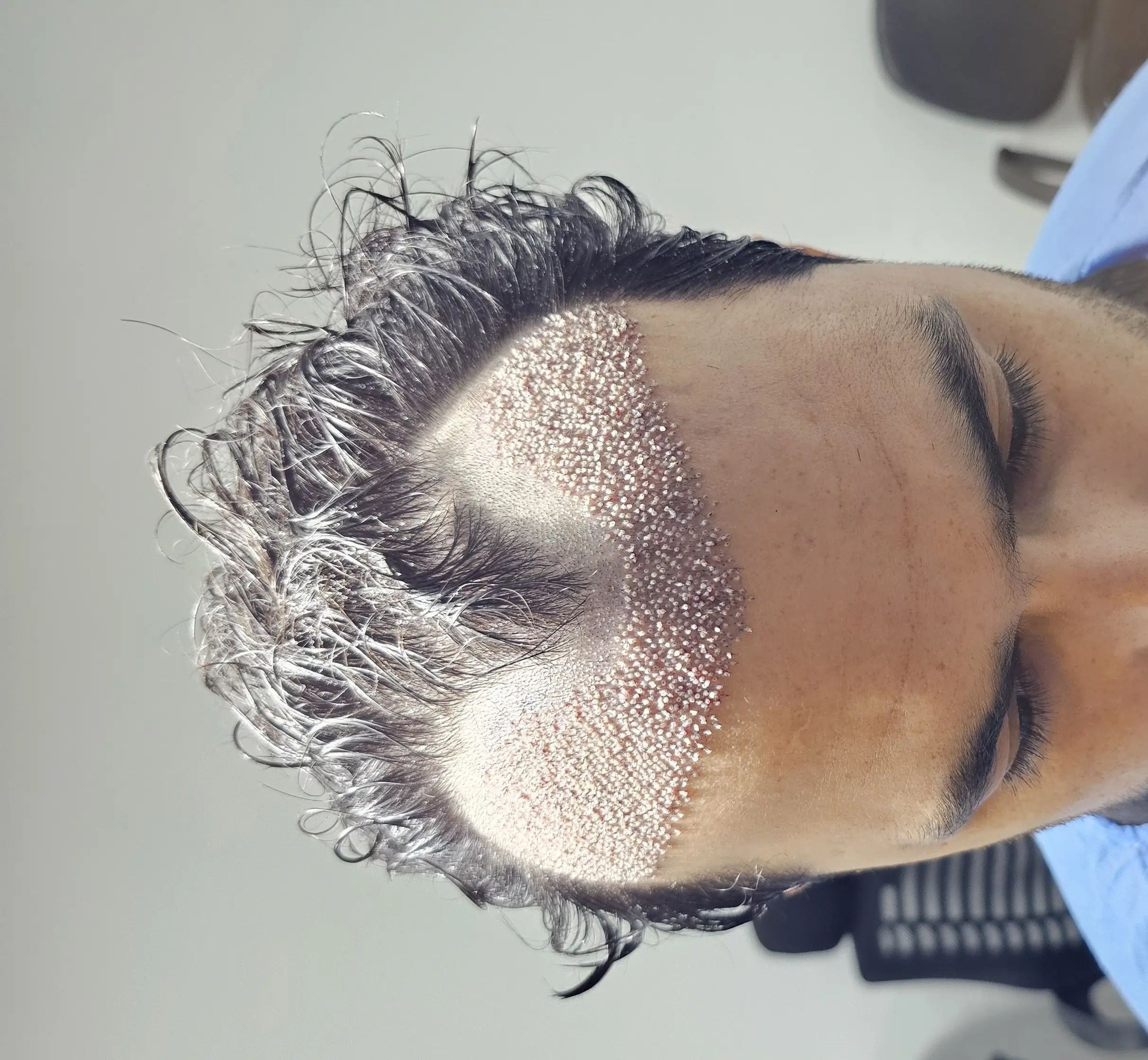 Hair transplant result - FUE 2500 Grafts