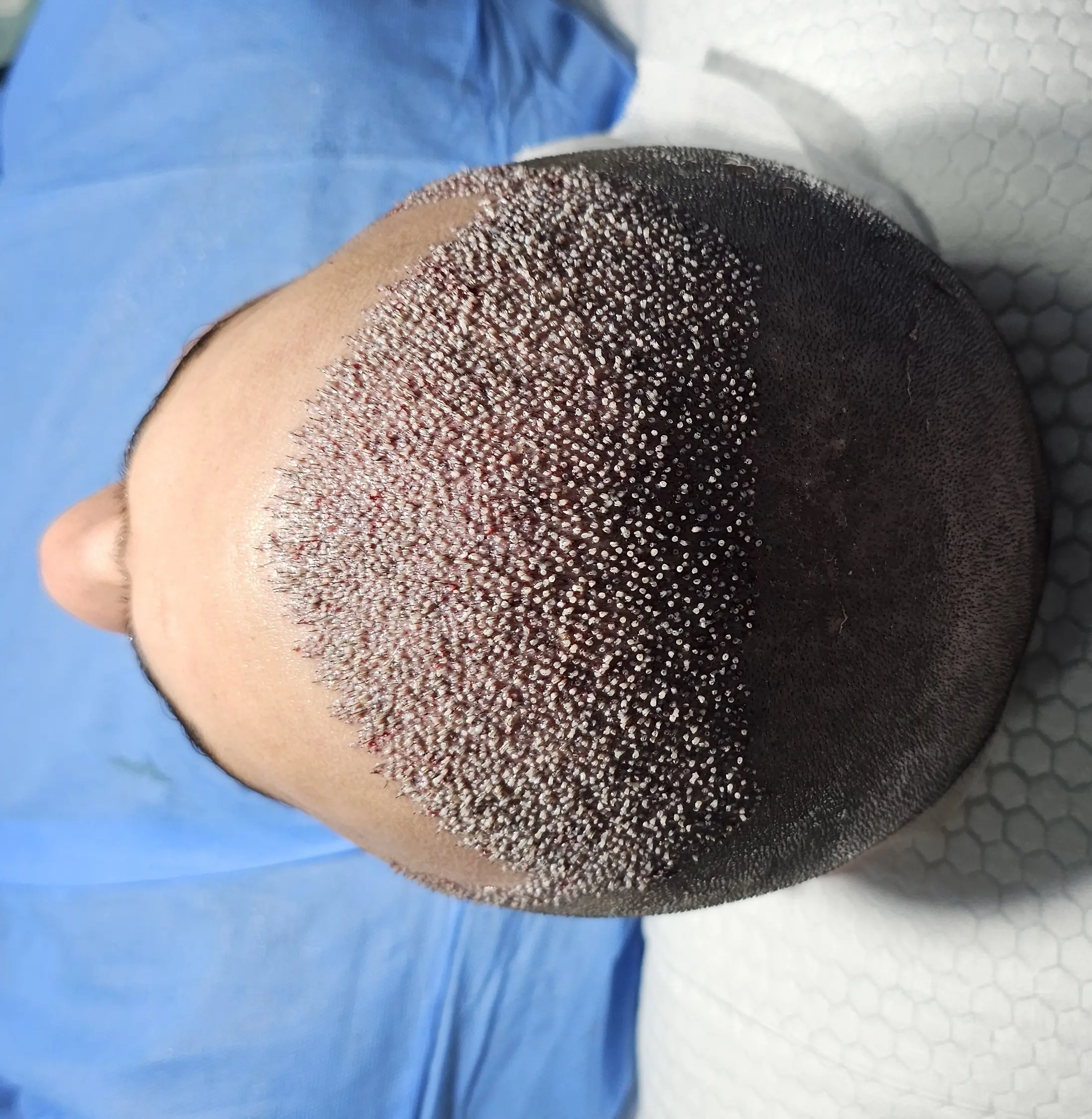 Hair transplant result - DHI 4000 Grafts