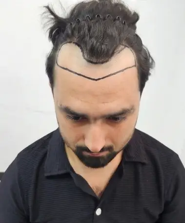 Before hair transplant